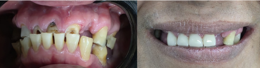 Caso 2: Coronas de Resina de Alta Estética