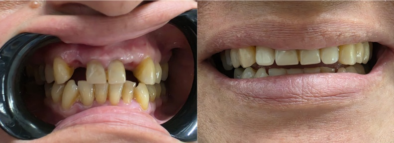 Caso 1: Reconstrucción con Prótesis Flexible de Alta Estética